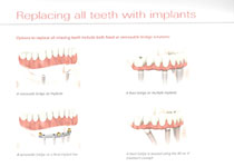 implant-denture-scan